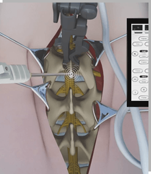 Navigation Guided Spine Surgery