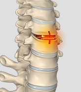 Revision Spine Surgery