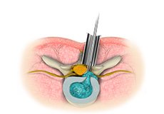 Microscopic Spine Surgery
