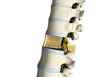 Osteoporosis of the Spine
