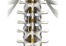 Spine Surgery in Athletes